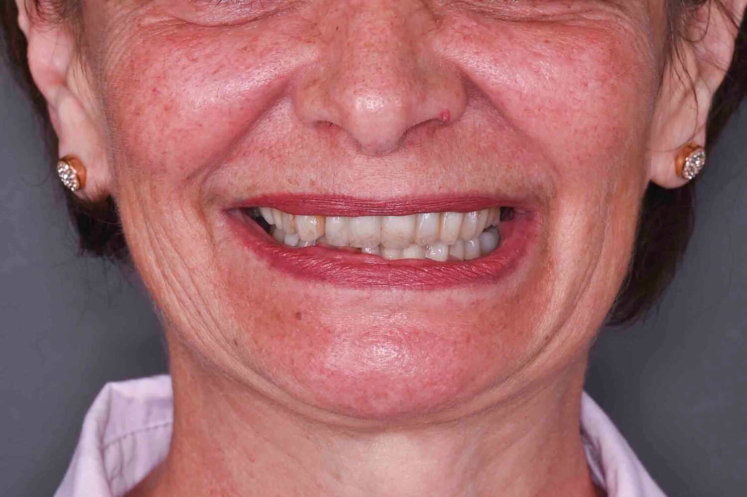 Pacient Clinica Dr. Alin Odor - Rezultat Implantologie